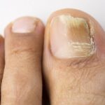 cómo eliminar las uñas amarillas y gruesas de los pies